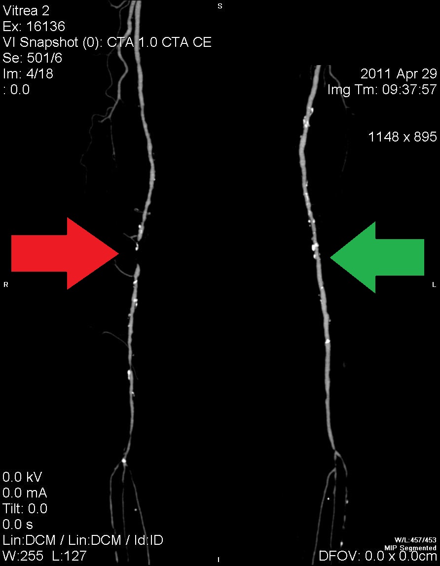 Prikaza stegensko kolenskega predela ožilja obeh nog, kaže na zaporo femoralne arterije na desni strani.
