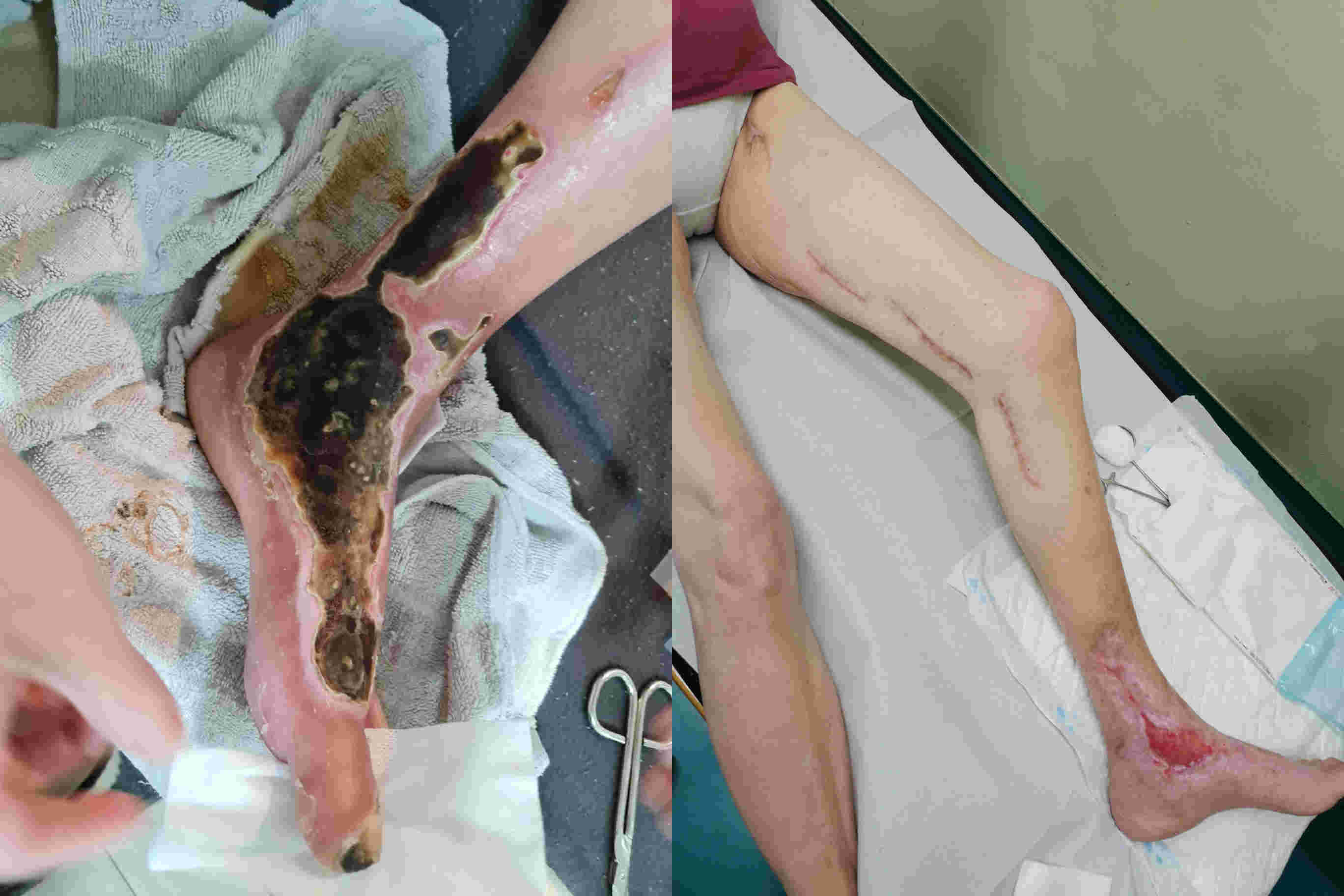Potem, ko se je znašla noga tik pred amputacijskim posego, je obvodna žilno kirurška operacija rešila nogo in dolgoročno tudi bolnico.