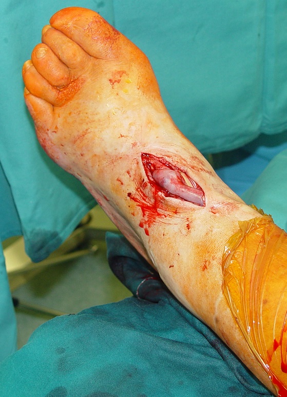 Anastomoza med veno in arterijo na stopalu deluje dobro