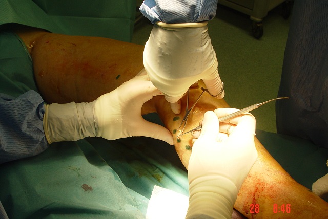 zličnih kirurških inštrumentov za izvlek žile iz podkožja, lahko gre za kljukico ali ma mali pean tako imenovani Mosquito.