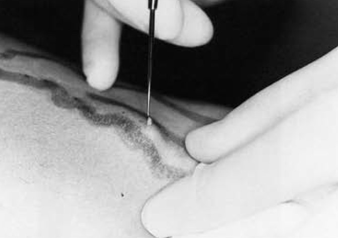 Žilni kirurg mora pri izvleku žile iz podkožja predvsem paziti, da se mu žila ne strže v naslednji fazi pa, da izvleče čim večji, daljši del žile.