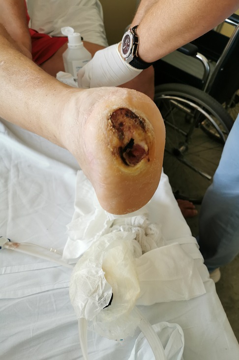 Pojav rane na stopalu po amputaciji skozi stopalo je posledica večjega pritiska zaradi manjše površine stopala in enake telesne teže bolnika.