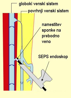 Endoskopsko zdravljenje krčnih žil