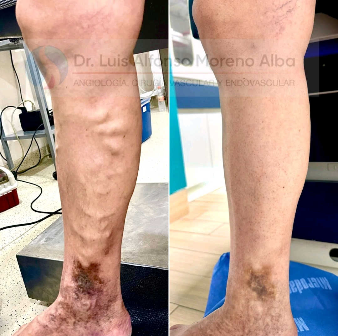 Z lasersko operacijo na krčnih žilah preperečimo, da bi kožne spremembe napredovale v kronično rano, ki bi se ne celila.