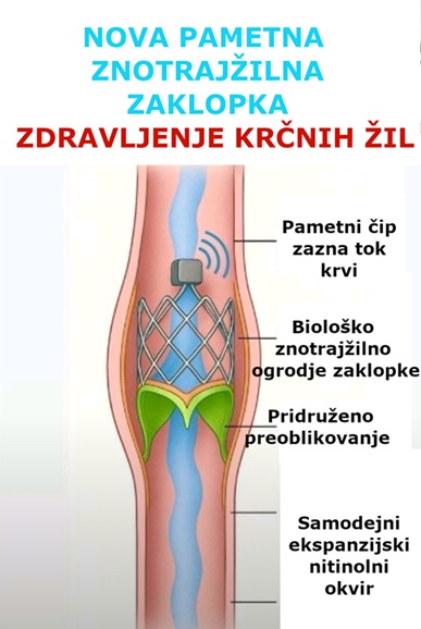 Formacija nove zaklopke pri krčnih žilah bi pomenila zasuk zdravljenja iz smeri destrukcije v smer konstrukcije.