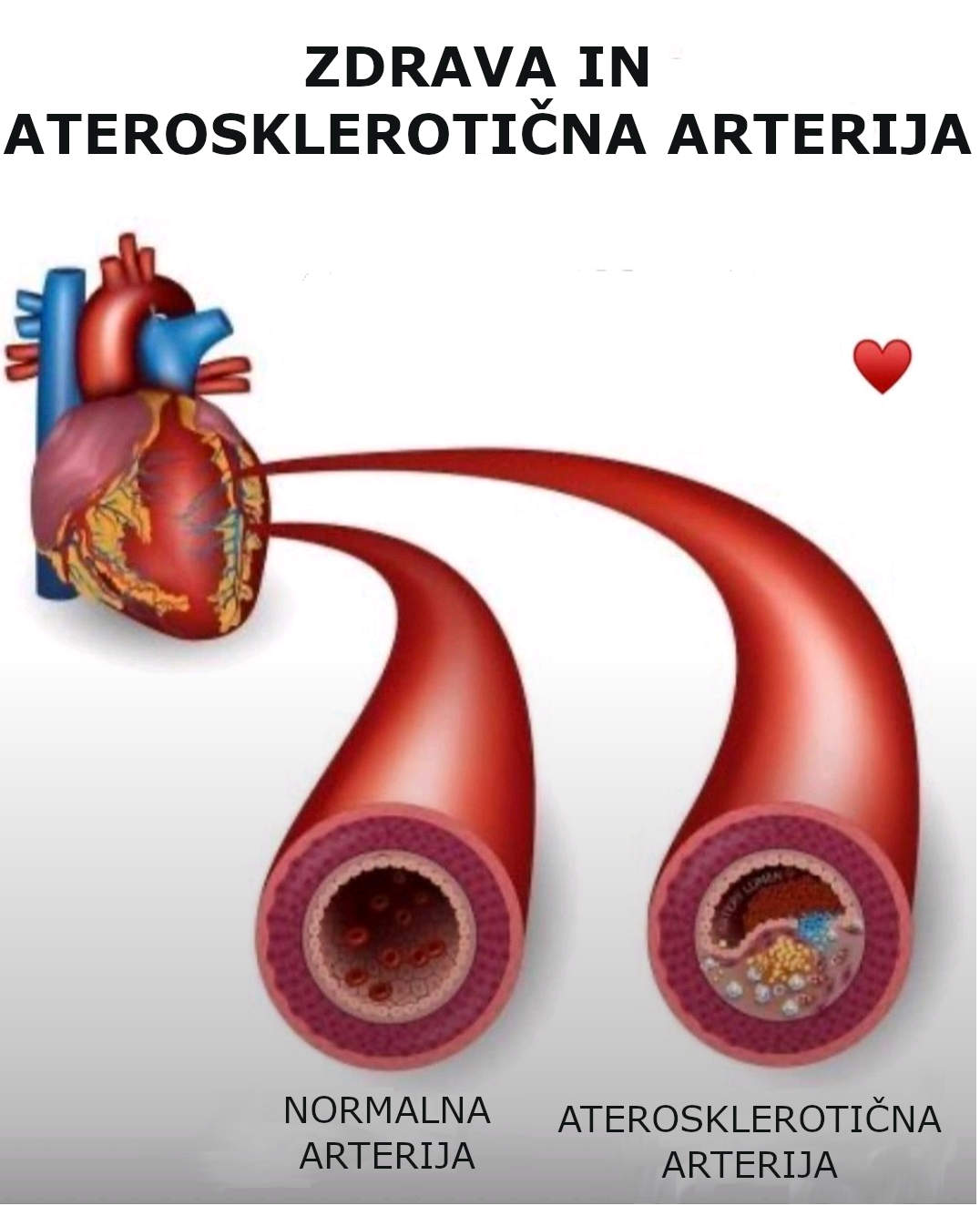 Hrana se nalaga v žilni steni in zapira prehodnost žile.
