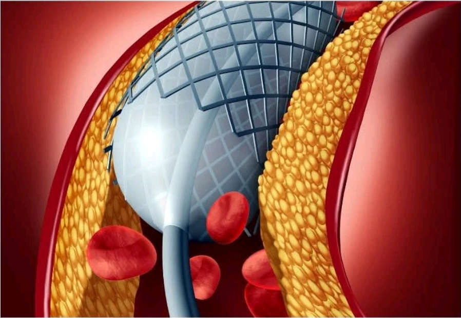 Vstavitev žilne opornice v arterijo preprečuje odmiranja organov, če gre za vitalne organe, srce, možgani, žilne opornice rešujejo življenja.