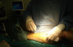 laserska operacija krčnih žil