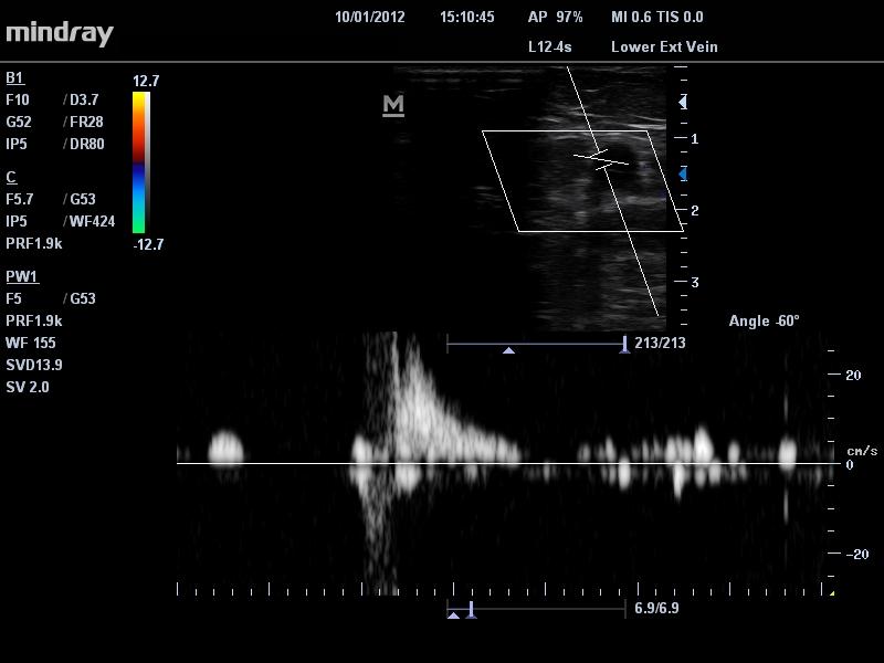 Ultrazvočni aparat za pregled krčnih žil