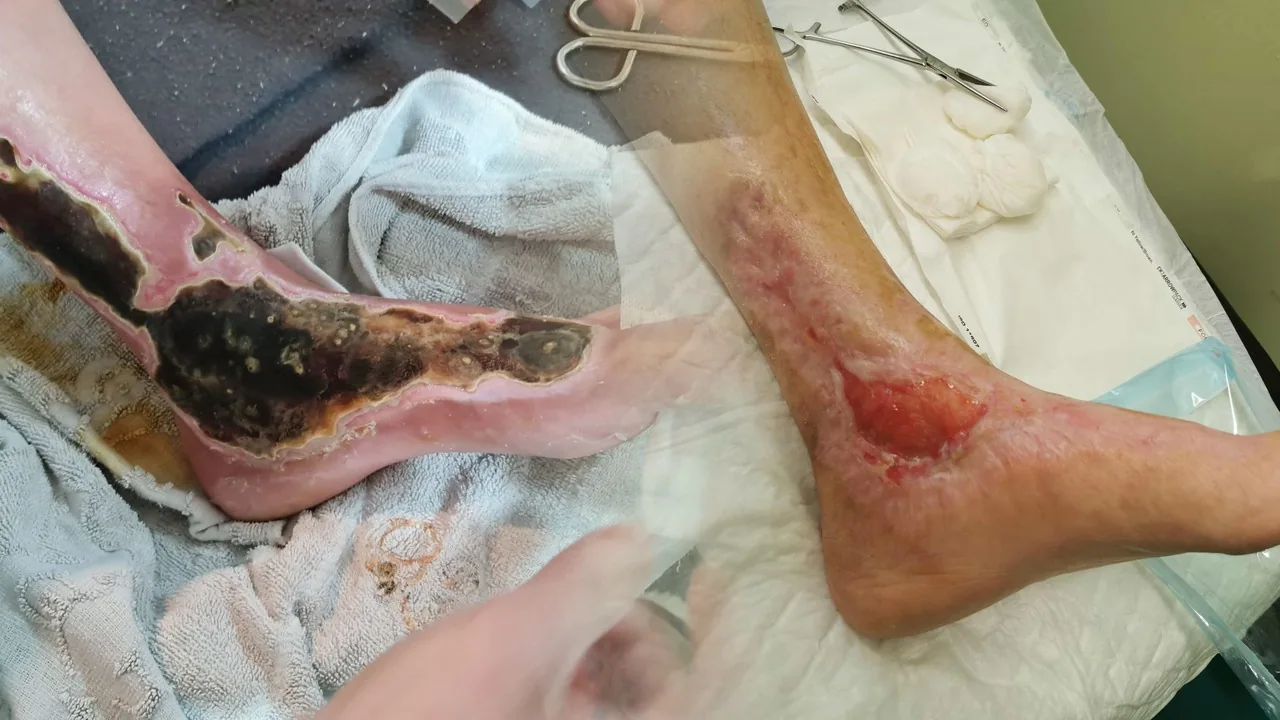 Reševanje uda pri bolezni arterij