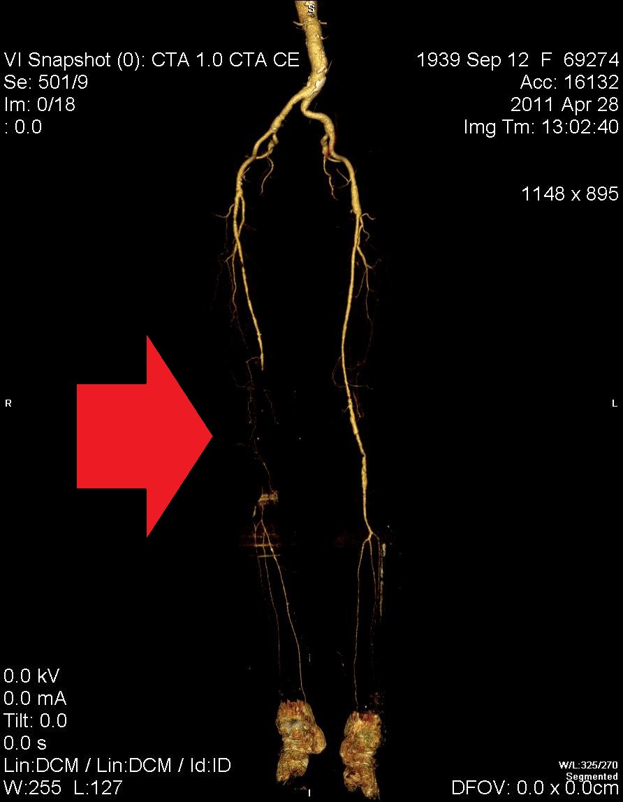 Dolga zapora na femoropoplitealni arteriji desne noge, potrebno bo razmisliti o obvodni operaciji.