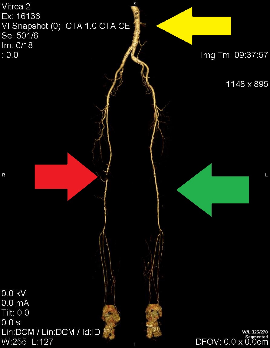 CTA prikaz žilja obeh nog vključno z abdominalno aorto.