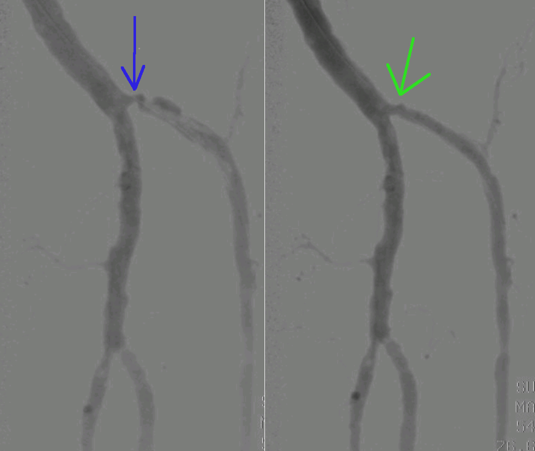 PTA poseg je omogočil ponovno prehodnost zožene žile.
