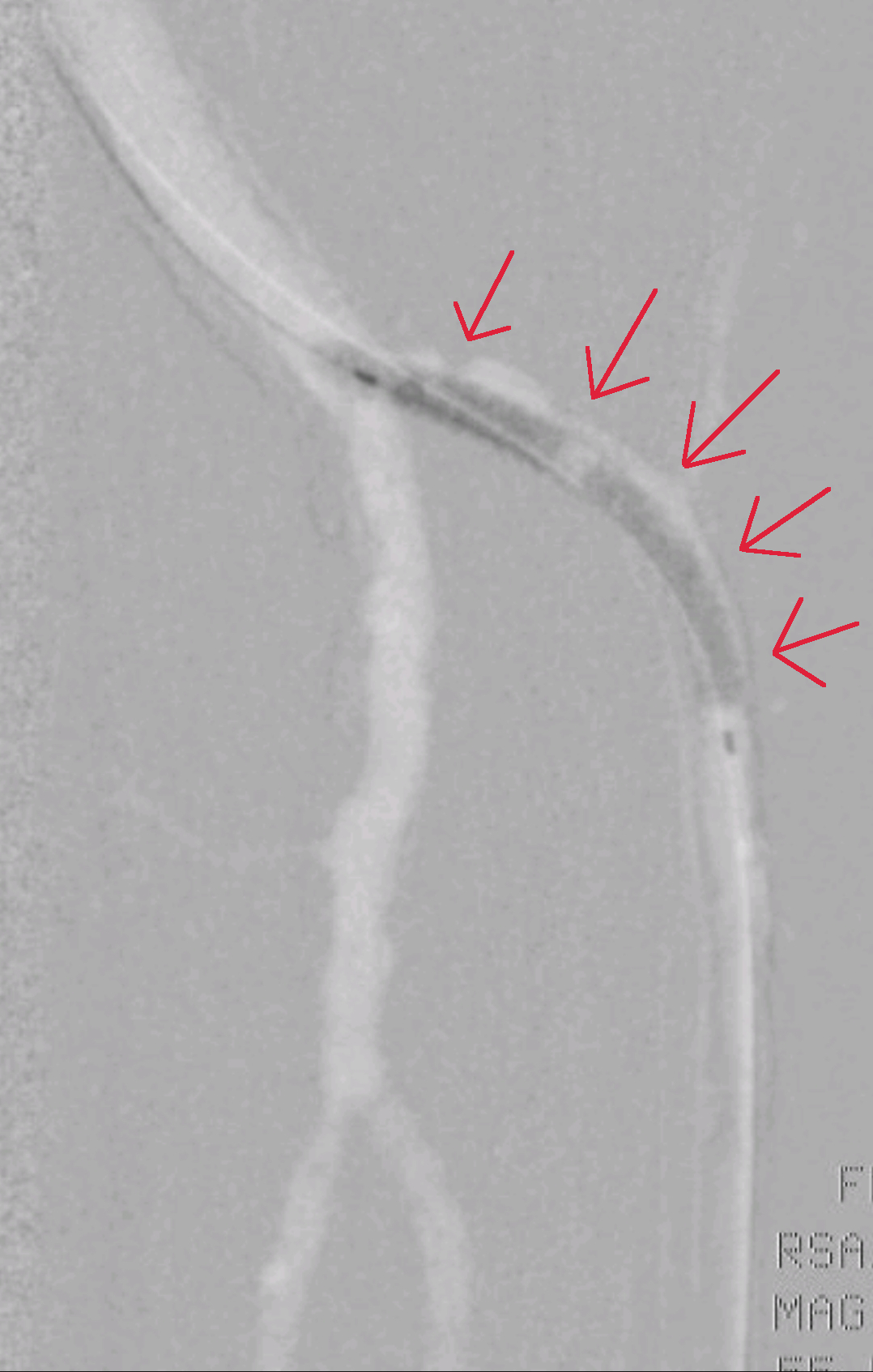 Prvi manever razširejnja zožene žile je razširitev žile z balonom.