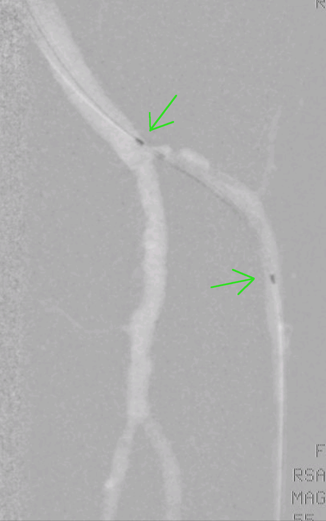 Vodilno žico uvedemo v arterijo in tako omogočamo prvailno pozicioniranje balona.