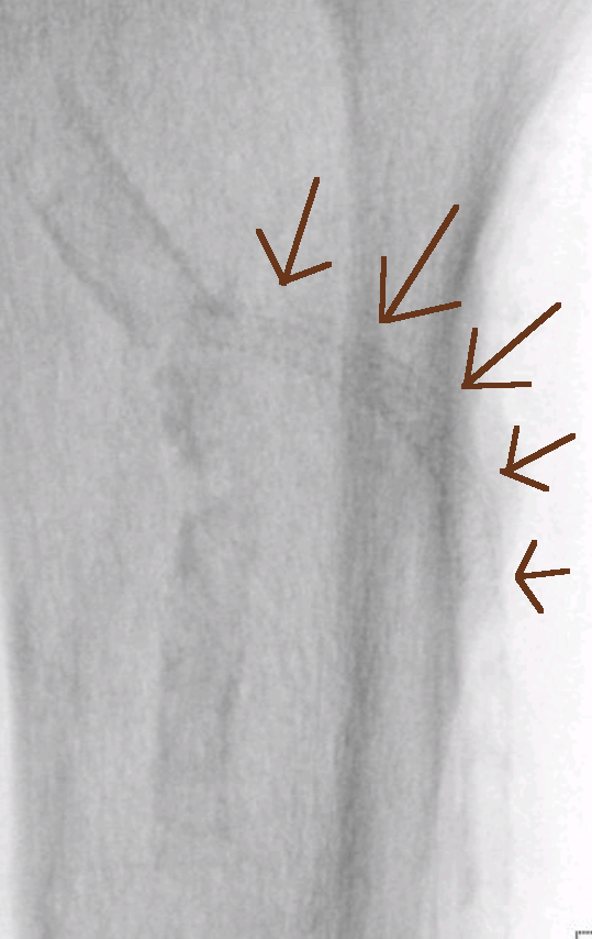 Z namestitvijo žilne opornice smo dosegli dolgoročno dober rezultat prehodnosti žile arterije in pri temu morda rešili nogo pred amputacijo