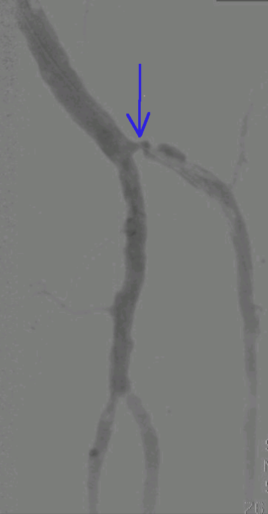 Zožena žila nastane v procesu ateroskleroze, ki ga stimuliramo z kajenjem, nezdravo prehrano, nezdravim življenskim slogom, pomanjkanjem gibanja, povečano telesno težo.