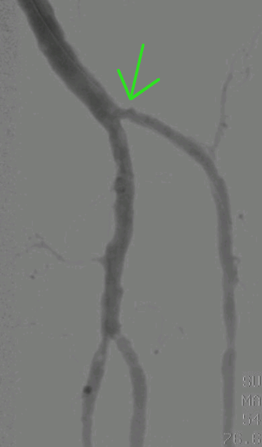 Ponovna vzpostavitev pretoka po zoženi arteriji.