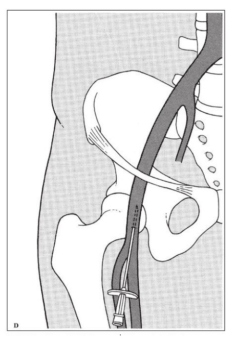 Skica vstopa igle v arterijo femoralis communis pri za znotrajžilni poseg na arterijskem sistemu.