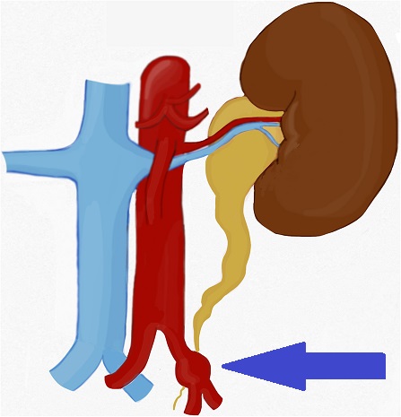 Anevrizma s svojo velikostjo pritisne na sosednje strukture. Pritisne lahko na sečevod in povzroči motnjo odtoka urina.