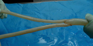 V primeru vnete žilne proteze, ki jo je potrebno odstraniti, zamenjamo slednjo s protezo, ki je zgrajena iz perikardija goveda.
