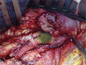 umetno aortno protezo, ki nima lastnega mehanizma za zdravljenje, pride do hudih sprememb v smislu vnetja in krvavitve.