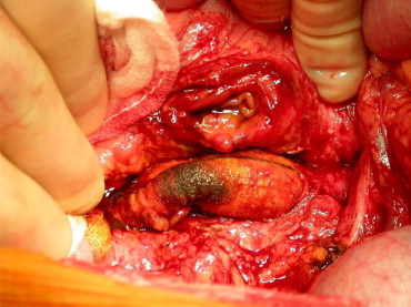 Reševanje vnete žilne proteze po operaciji anevrizme trebušne aorte zahteva kompleksno zdravljenje kirurškega tima.