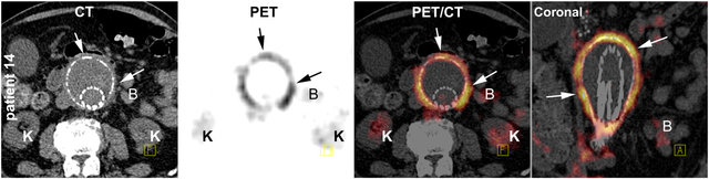 PET CT scan je ciljna diagnostična metoda pri ugotavljanju vnetja žilne proteze po operaciji anevrizme trebušne aorte.