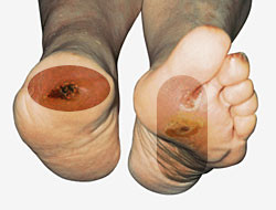 Težava pri diabetičnemu stopalu je nastanek rane, ki se ne celi