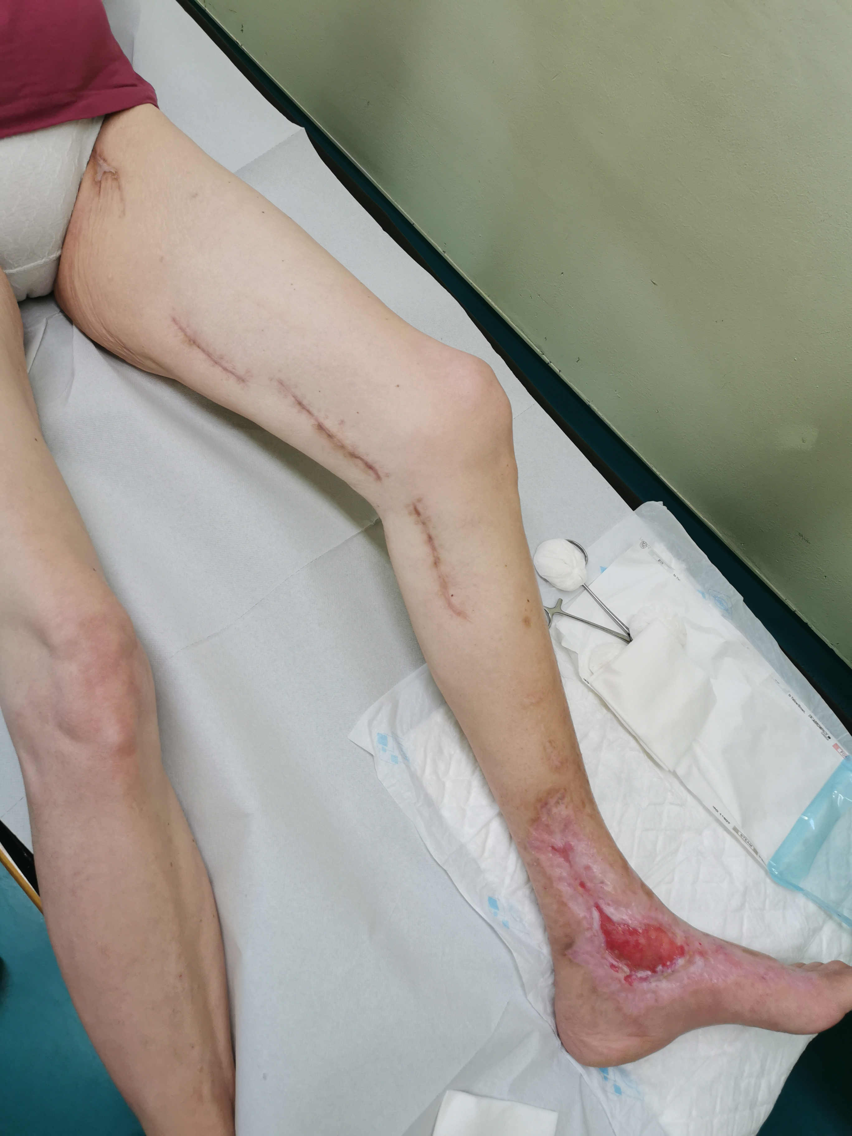 Brazgotine na nogi so lahko edini stranski učinek operativnega posega žile na nogi