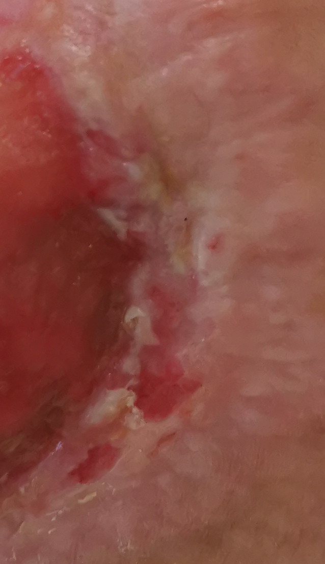 Končno celejenje rane prikaz med epitelizacijo in granulacijo, granulacija prehaja v epitelizacijo, mrtvin ni več