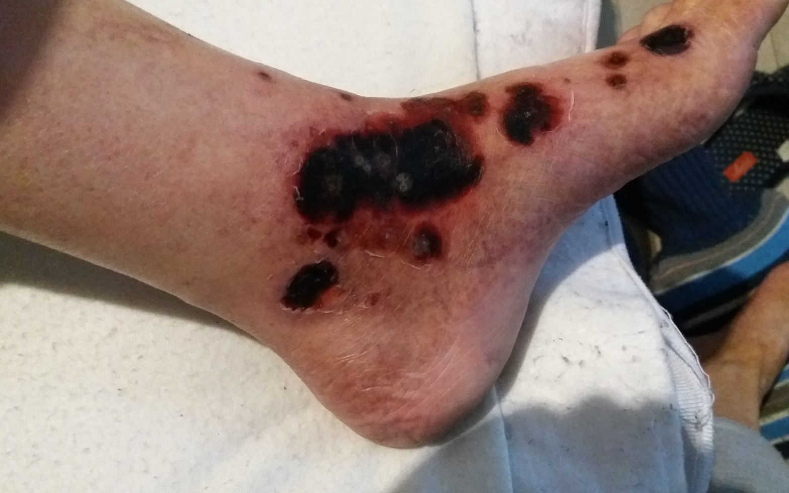Črnina na nogi je znak, da se z nogo nekaj dogaja in je potrebna diagnostika takoj in zdaj.