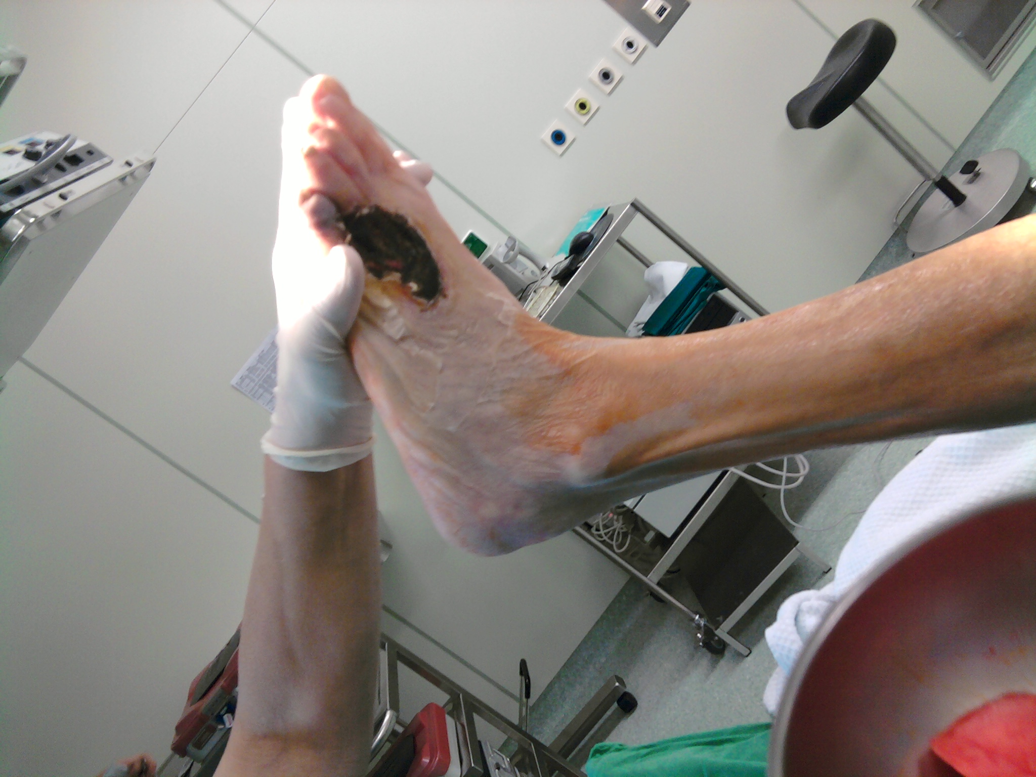 Gangrena na stopalu je lahko prvi znak, da je z arterijami na goleni nekaj narobe