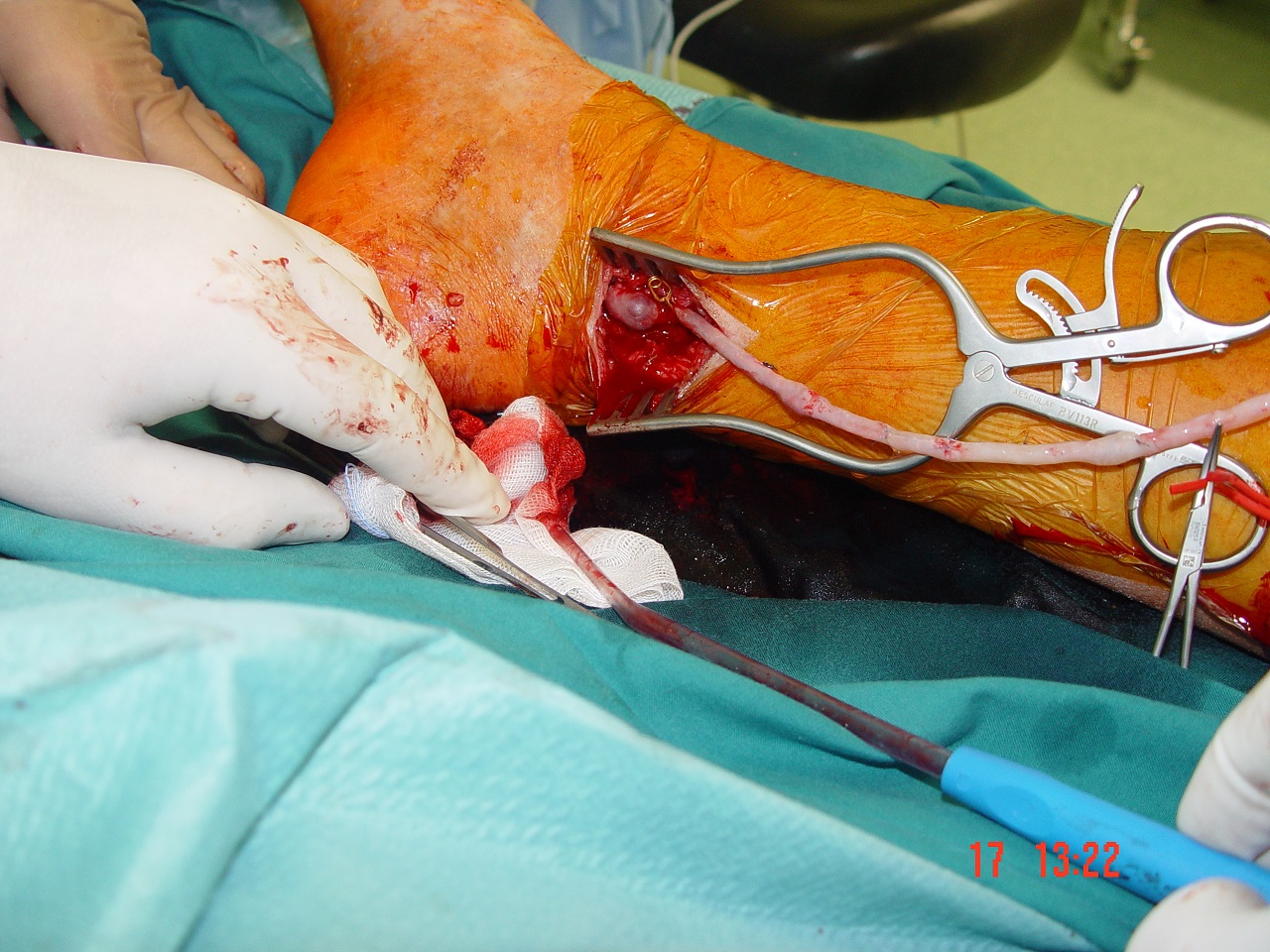 Anastomoza med veno safeno magno in arterijo na stopalu