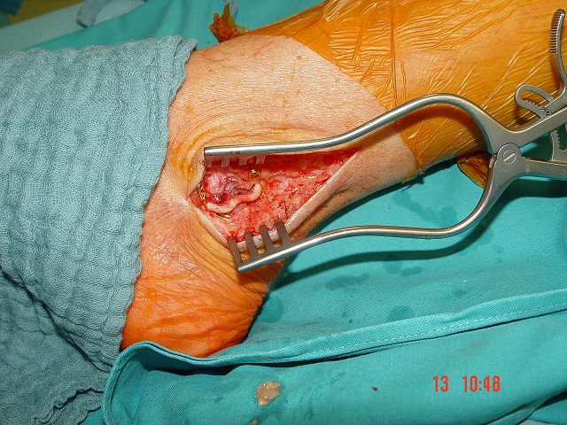 Arterija na stopalu primerna za distalno anastomozo z veno pri reševanju uda