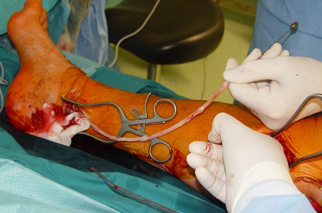Preizkus delovanja distalne anastomoze pri pedalnemu obvodu z lastno veno