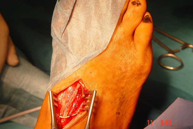 Arteriotomija na stopalu dokončno pokaže ohranjenost oziroma prizadetost sprejemne arterije pri pedalnemu obvodu