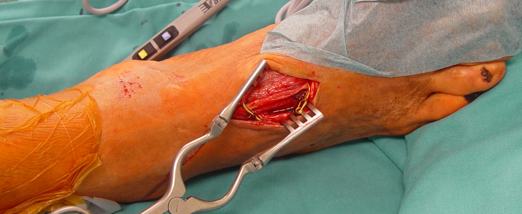 Arterija dorsalis pedis kot sprejemna arterija pri premostitveni operaciji na stopalo