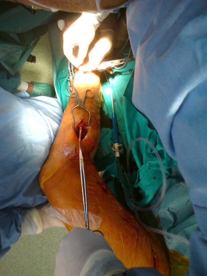 Šivanje proksimalne anastomoze med veno safeno magno revertirano in kolenčno arterijo
