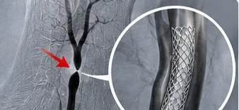 Angiografski prikaz vratne arterije in žilne opornice