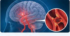 Medicinska ilustracija možganske prekrvitve in možganske kapi