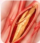 Medicinska ilustracija: Ponovna zožitev