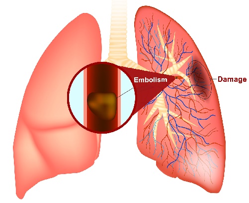 Pljučna embolija nastane, ko potuje krvni strdek v pljuča, težave se lahko začnejo s težkim dihanjem