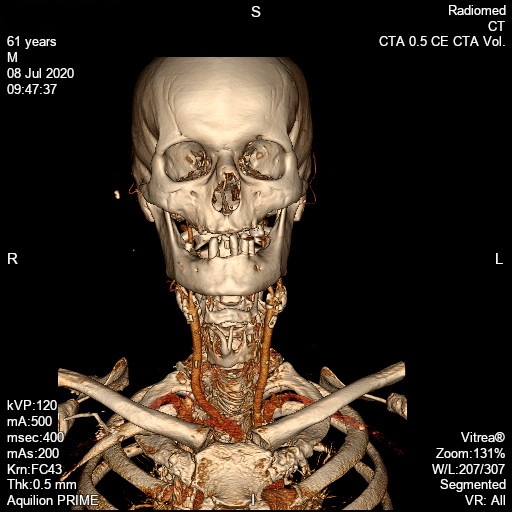Animirani anatomski prikaz vratnih arterij