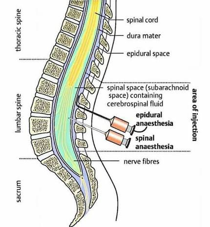 Anatomsko blizu epiduralnemu prostoru je spinalni prostor, kjer se nahaja likvor.
