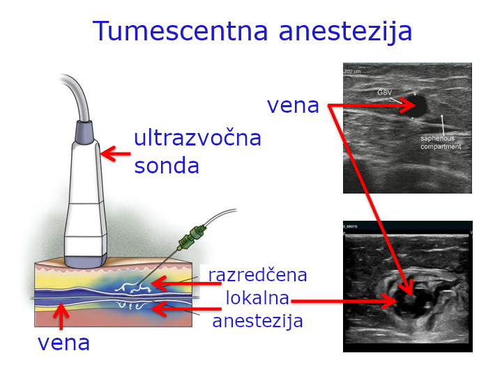 Tumescentna anestezija omogoča prehod številnih posegov iz splošne anestezije v preprostejše oblike anestezij.
