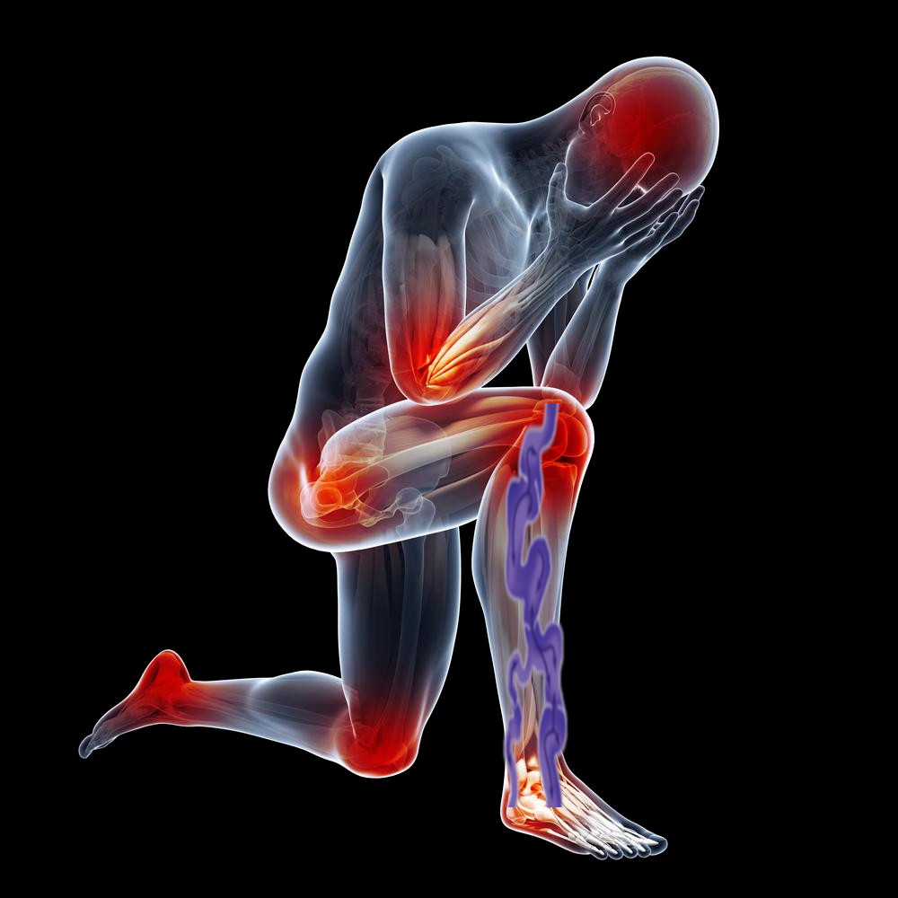 Krčne žile so bolne žile, postopoma dekompenzirajo zaradi pokončne drže in noge nas začnejo boleti proti večeru.