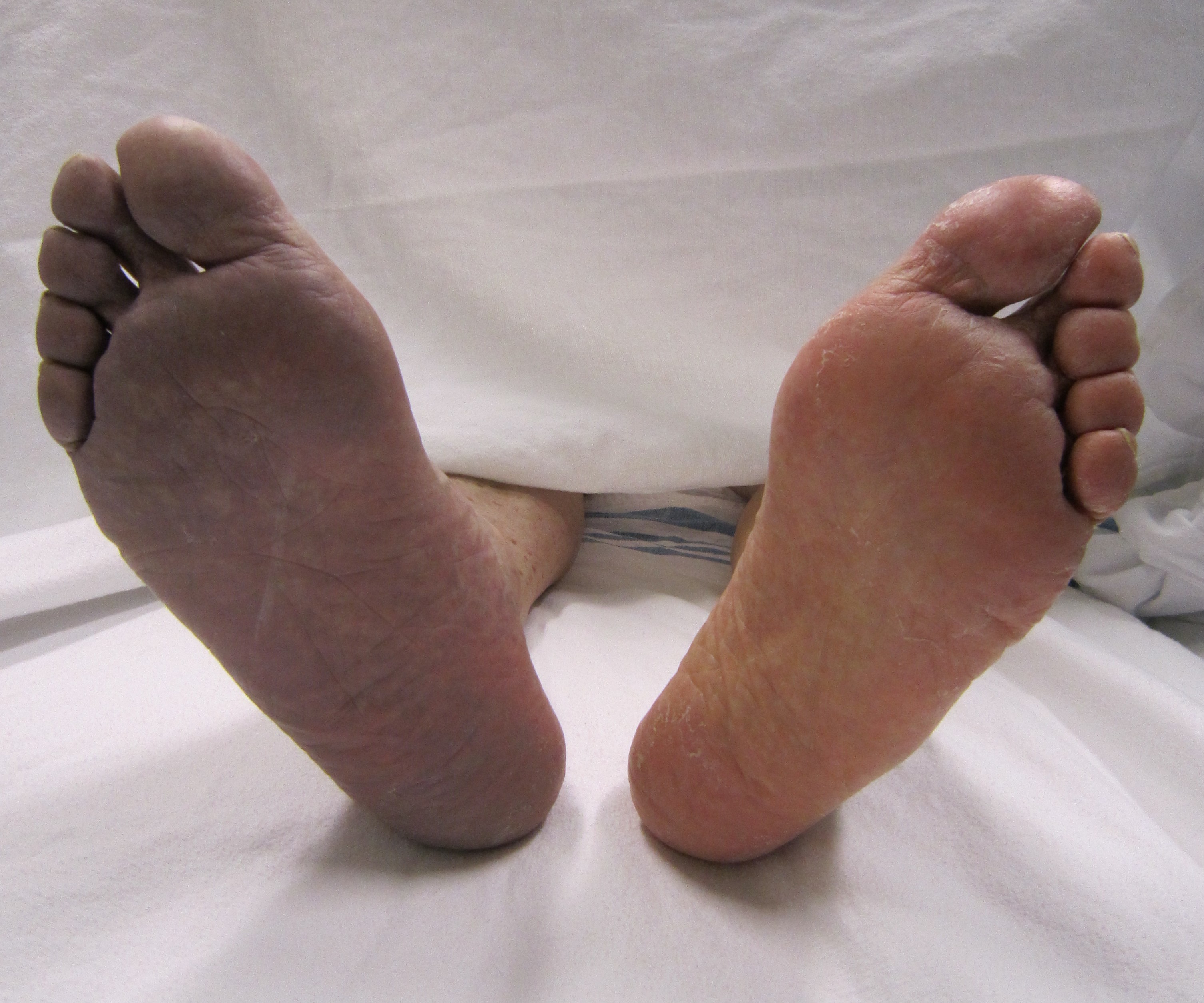 Spremenjena barva noge je alarmni znak, da je prekrvavitev motena, potrebno je takoj poiskati zdravniški nasvet.