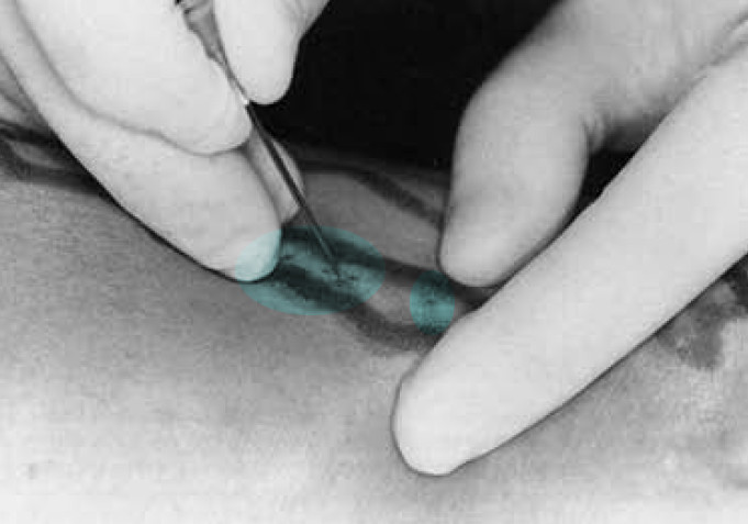 Koža, ki je prebodena s skalpelom, omogoča vstop inštrumentov do zvijuganih, krčnih žil.
