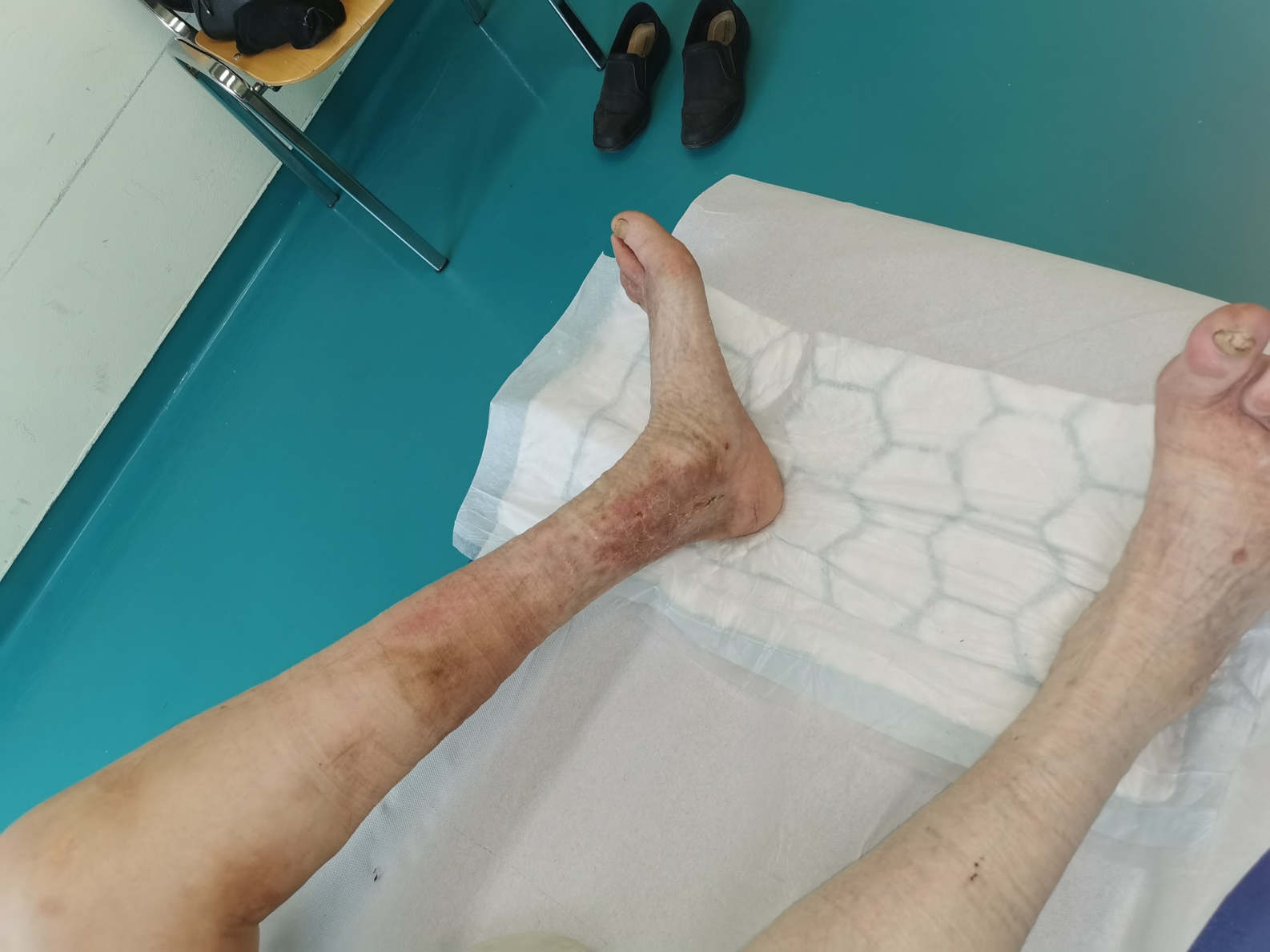Bolnik je štiri mesece po laserskemu posegu na krčnih žilah zadovoljen z rezultatom.